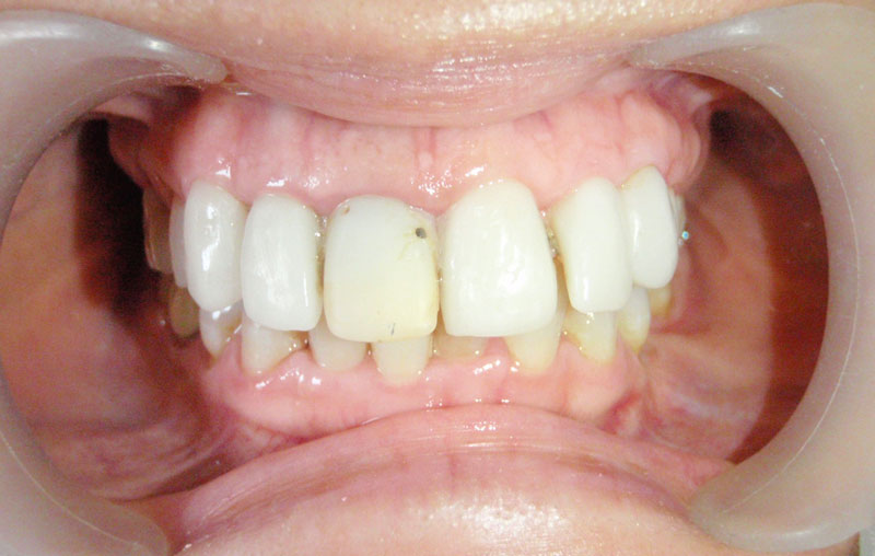 ORTHO-CROWN-CASE-BEFORE